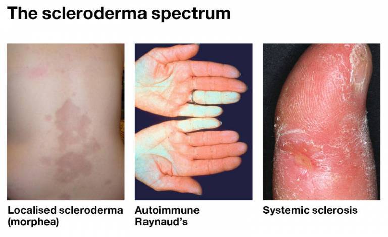 autoimmune phenomena symptoms