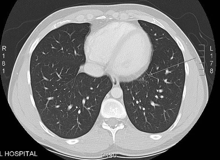 Mri lungs online