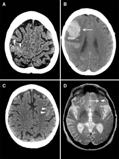 Stroke Research | UCL Queen Square Institute of Neurology ...