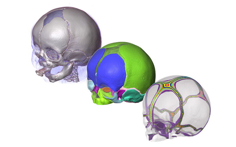 Three images of 3d skulls used in virtual surgery research