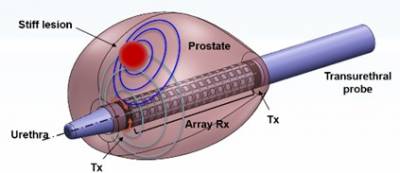 a diagram of a device inserted into a human prostate