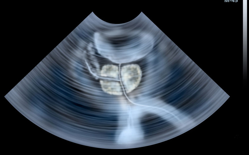 ultrasound image of a prostate