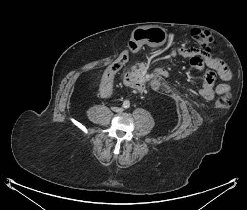 CT Colonography