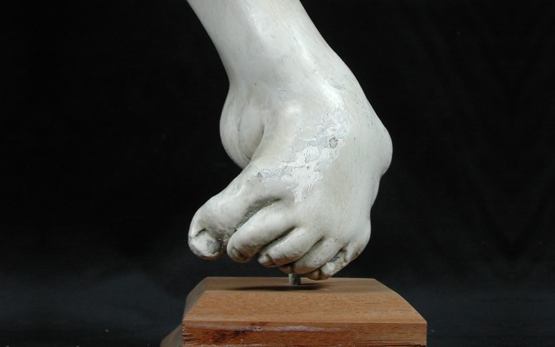 Plaster cast showing an example of extreme congenital talipes equino-varus, or club foot