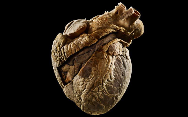 A heart showing pulmonary embolism