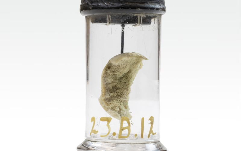 A piece of bone removed by pioneering surgeon, Robert Liston