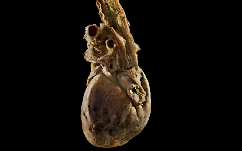 oesophagus and heart specimen with damage caused by a sword