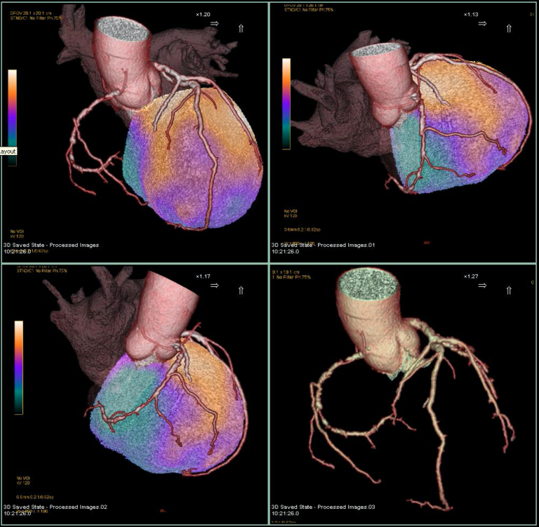 Cardiovascular Research | Institute Of Nuclear Medicine - UCL ...