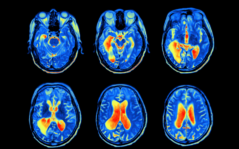 Six brain scans side by side