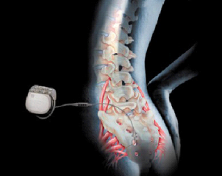 Neuromodulation device