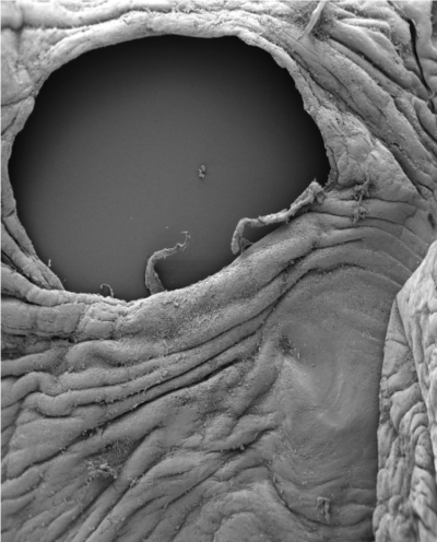 Hole in amniotic membrane
